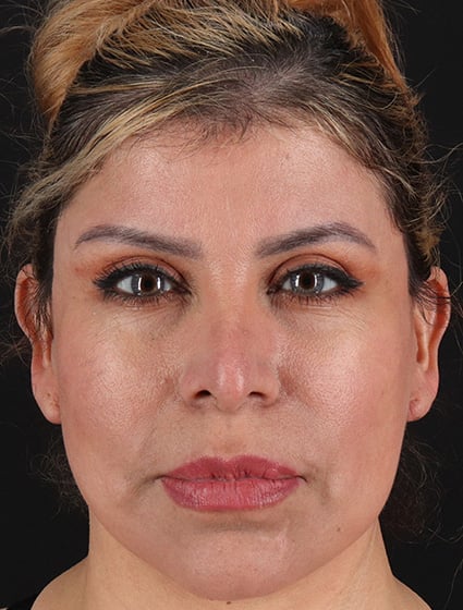 After-66072-Facelift+Necklift-Dr.Fairchild 1-cropped