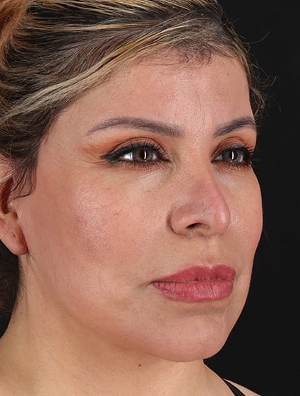 After-66072-Facelift+Necklift-Dr.Fairchild 2-cropped