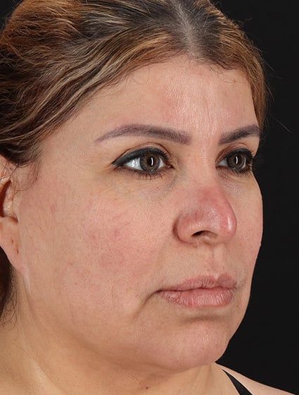 Before-66072-Facelift+Necklift-Dr.Fairchild 2-cropped