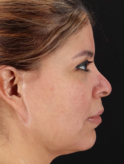 Before-66072-Facelift+Necklift-Dr.Fairchild 3-cropped