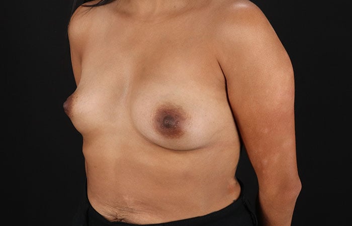 case-34081-left-oblique-before