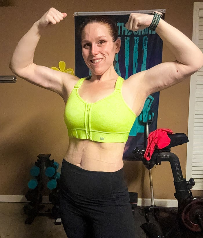 Breast Back Arm Lift After-1