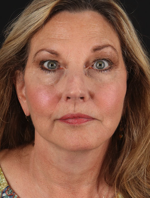 after facelift