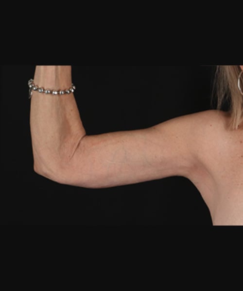 arm-lift-1--front-after
