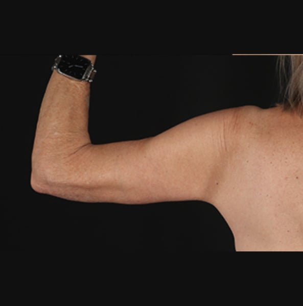 arm-lift-1-back-after