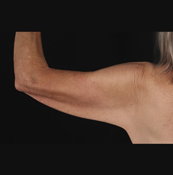 arm-lift-1-back-before