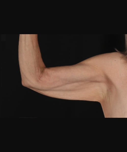 arm-lift-1-front-before