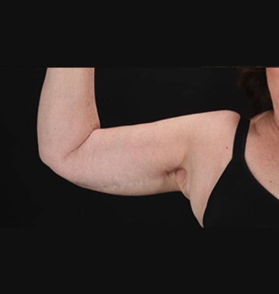 arm lift after - front view