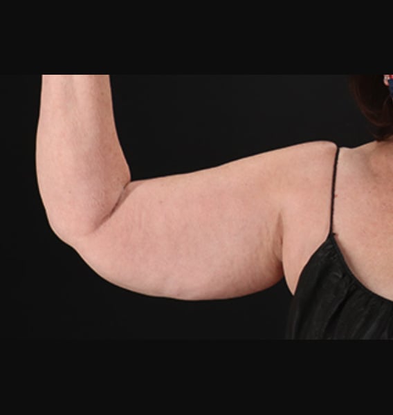 arm lift before - front view