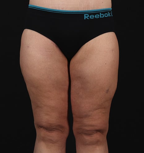 thigh-lift-after