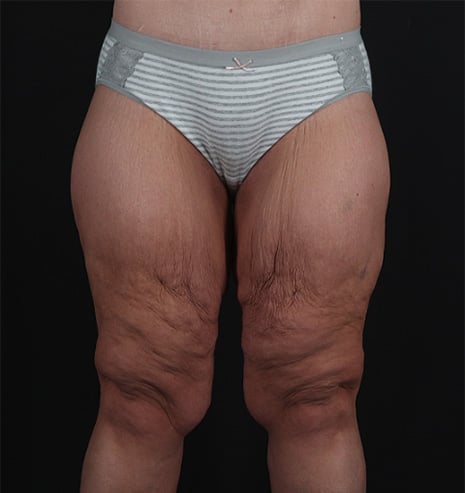 thigh-lift-before