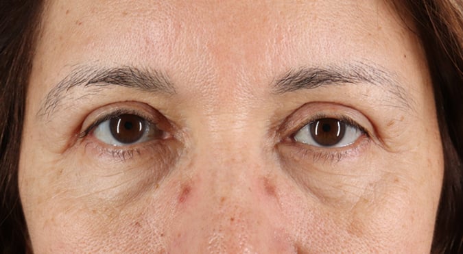 Rednam_Belpharoplasty_1_After