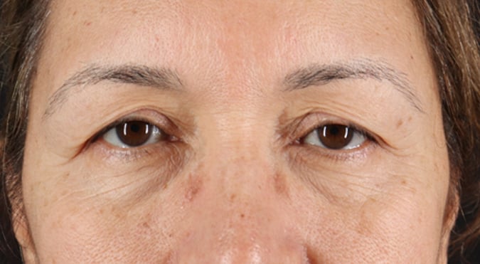 Rednam_Belpharoplasty_1_Before