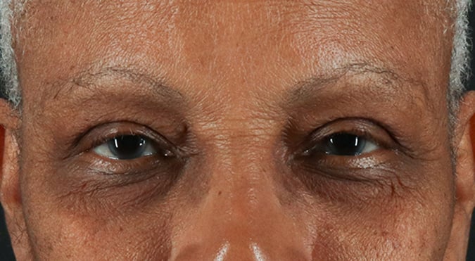 Rednam_Belpharoplasty_3_After