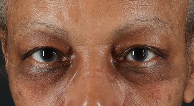 Rednam_Belpharoplasty_3_Before