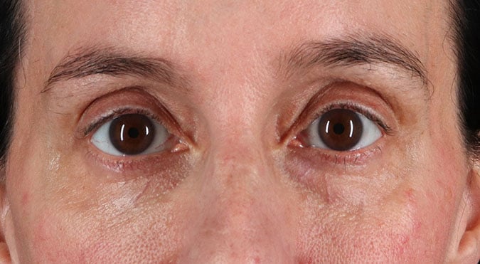 Rednam_Belpharoplasty_4_After