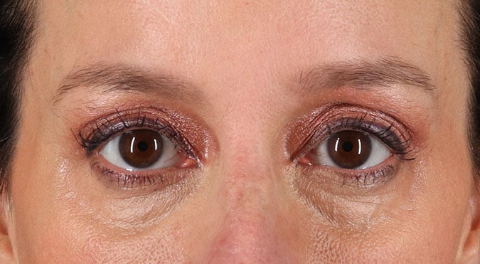 Rednam_Belpharoplasty_4_Before