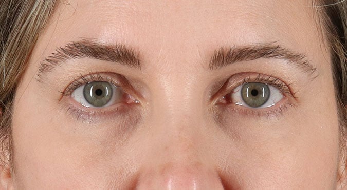 Rednam_Belpharoplasty_5_After