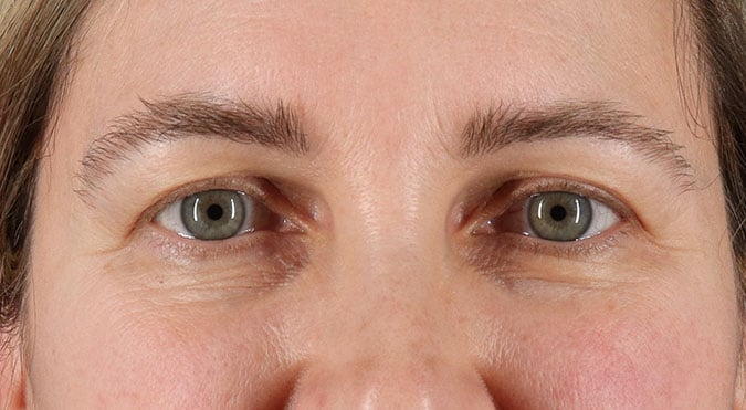 Rednam_Belpharoplasty_5_Before